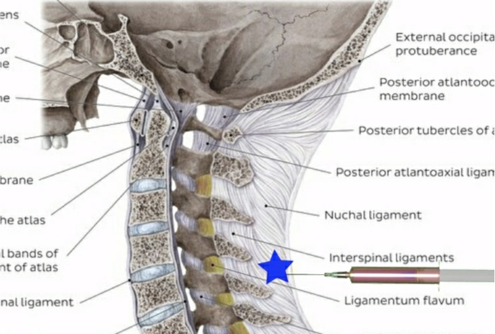 Атлантозатылочный сустав связки. Заднюю атланто затылочную мембрану прободает нерв. Атланто окципитальный сустав. Связки атланто аксиального сустава. Заднюю атланто затылочную мембрану прободает нерв.